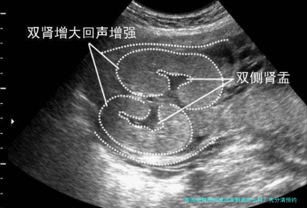 泰国试管预约成功率到底怎么样?先分清预约和成功率再决定